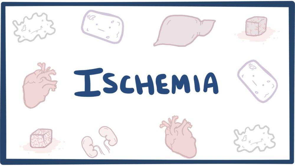 Ecco l'ischemia.