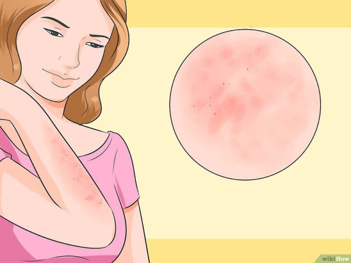 Come Riconoscere Una Puntura Di Scorpione