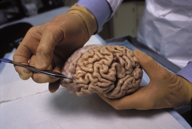 Alcune pratiche mediche possono trasmettere l'Alzheimer