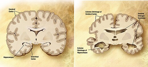 I test per la diagnosi precoce di Alzheimer